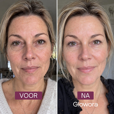 Voor-en-na vooraanzicht van een vrouw na gebruik van de PDRN Niacinamide Crème