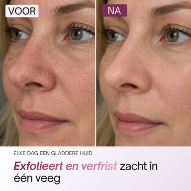 Voor-en-na close-up van neus en wang na gebruik van de Kojic Acid Pads