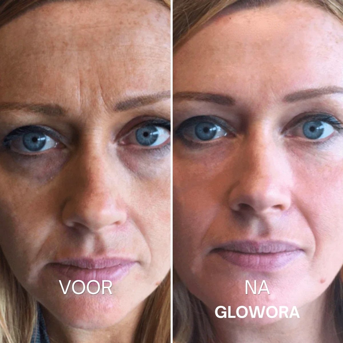 Voor en na Glowora