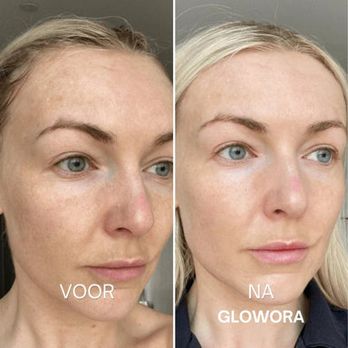 Voor en na Glowora
